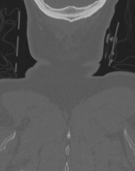 Cerebral hemorrhagic contusions and cervical spine fractures (Radiopaedia 32865-33841 Coronal bone window 80).jpg