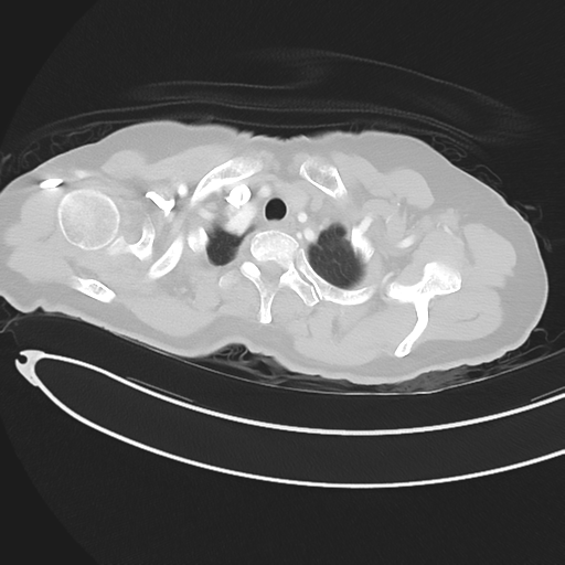 Cerebral metastases (Radiopaedia 33041-34055 Axial lung window 8).png