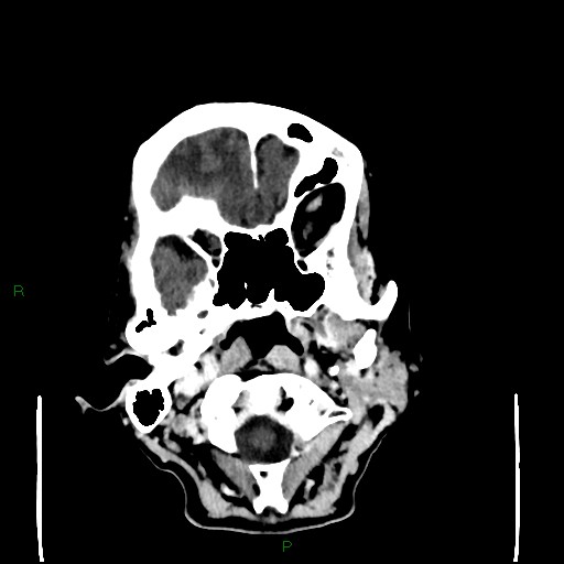 File:Cerebral metastases - breast primary (Radiopaedia 77653-89857 Axial C+ delayed 18).jpg