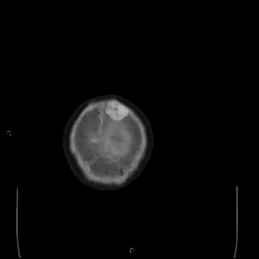 Cerebral metastases - breast primary (Radiopaedia 77653-89857 Axial bone window 115).jpg