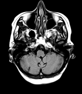 File:Cerebral metastasis (Radiopaedia 46744-51248 Axial FLAIR 5).png