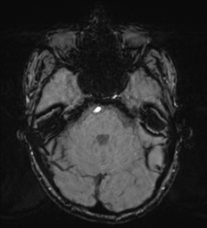 File:Cerebral metastasis - melanoma (Radiopaedia 54718-60954 Axial SWI 16).png