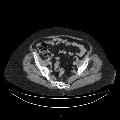 Cerebral metastasis from renal cell carcinoma (Radiopaedia 82306-96378 A 154).jpg