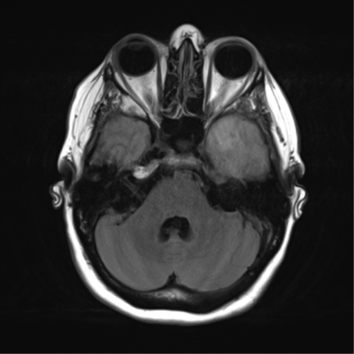 File:Cerebral metastasis mimicking glioblastoma (Radiopaedia 69155-78937 Axial FLAIR 10).png