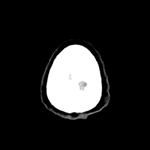 Cerebral metastasis to basal ganglia (Radiopaedia 81568-95412 Axial C+ delayed 54).png