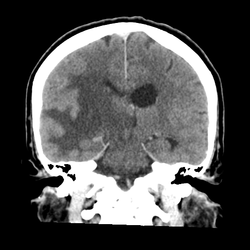 Cerebral metastasis to basal ganglia (Radiopaedia 81568-95412 Coronal C+ delayed 36).png