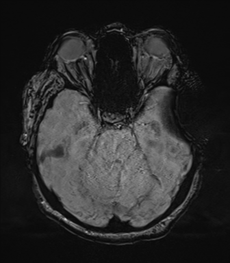 Cerebral metastasis to basal ganglia (Radiopaedia 81568-95413 Axial SWI 26).png