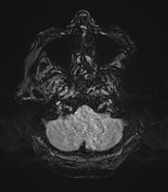 Cerebral metastasis to basal ganglia (Radiopaedia 81568-95413 Axial SWI 9).png