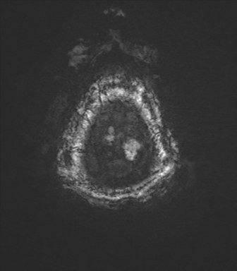 Cerebral metastasis to basal ganglia (Radiopaedia 81568-95413 Axial SWI magnitude 88).png