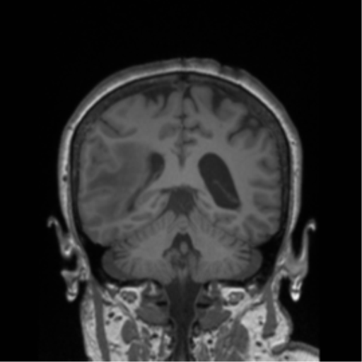 File:Cerebral metastasis to basal ganglia (Radiopaedia 81568-95413 Coronal T1 13).png