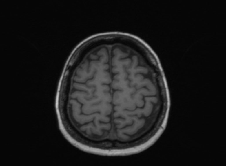 Cerebral ring enhancing lesions - cerebral metastases (Radiopaedia 44922-48817 Axial T1 141).jpg