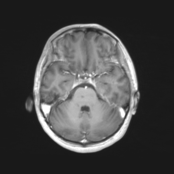 File:Cerebral toxoplasmosis (Radiopaedia 53993-61435 Axial T1 6).jpg