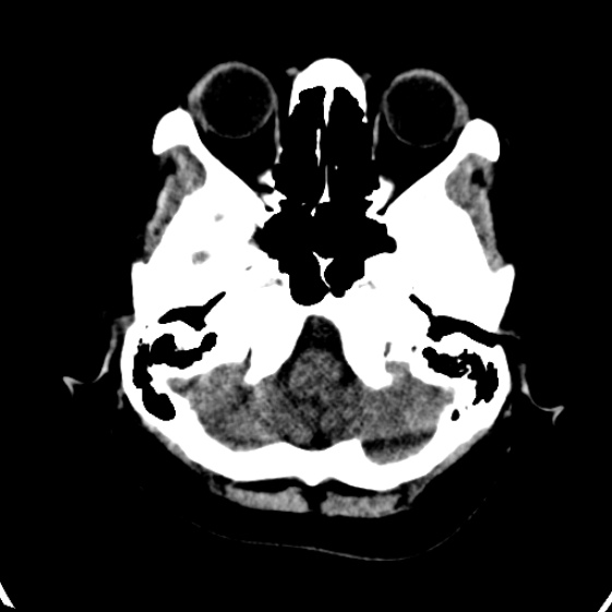 File:Cerebral venous hemorrhagic infarct from venous sinus thrombosis (Radiopaedia 55433-61879 Axial non-contrast 3).jpg