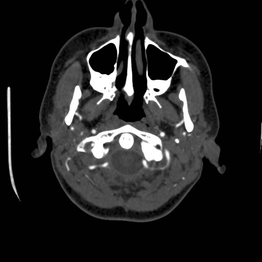 Cerebral venous sinus thrombosis (Radiopaedia 40619-43227 A 11).jpg