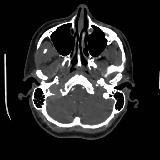Cerebral venous sinus thrombosis (Radiopaedia 40619-43227 A 36).jpg