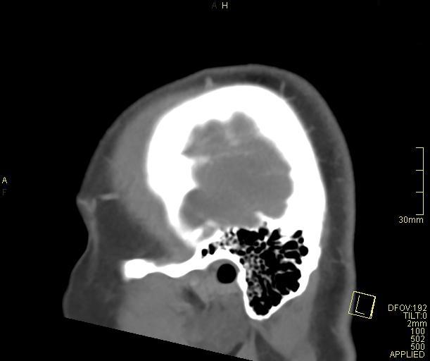 File:Cerebral venous sinus thrombosis (Radiopaedia 91329-108965 Sagittal venogram 68).jpg