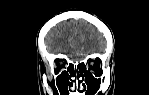 Cerebral venous thrombosis (CVT) (Radiopaedia 77524-89685 C 12).jpg