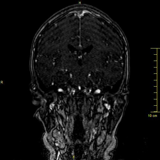 File:Cerebral venous thrombosis (Radiopaedia 23288-23351 MRV 79).JPG