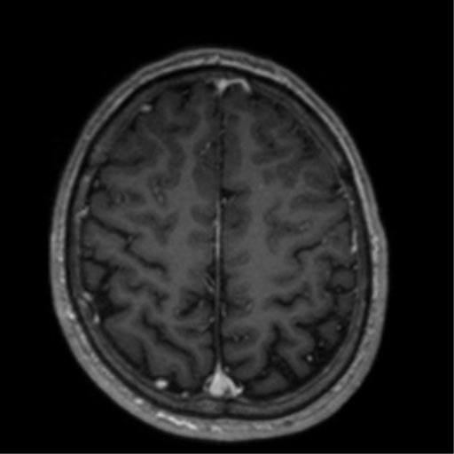 Cerebral venous thrombosis (Radiopaedia 38392-40469 Axial T1 C+ 61).png