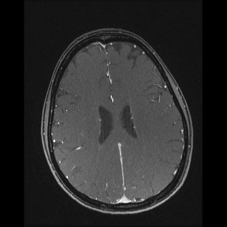 Cerebral venous thrombosis (Radiopaedia 45678-49854 Axial MRV 49).jpg