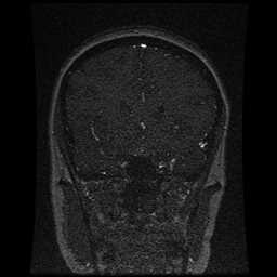 Cerebral venous thrombosis - ulcerative colitis (Radiopaedia 66049-75219 Coronal MRV 79).jpg
