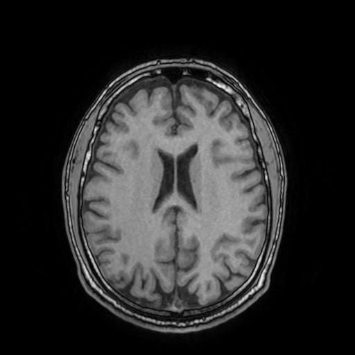 File:Cerebral venous thrombosis with secondary intracranial hypertension (Radiopaedia 89842-106957 Axial T1 112).jpg