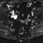 Cervical adenocarcinoma (Radiopaedia 65011-73985 Axial DWI 58).jpg