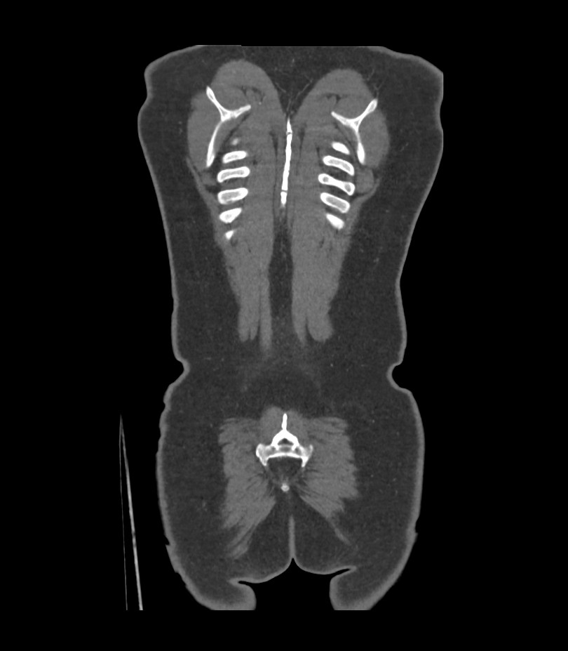Cervical aortic arch with coarctation and aneurysms (Radiopaedia 44035-47552 C 1).jpg