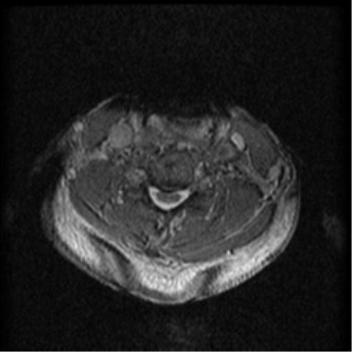 Cervical canal stenosis with cord compression (Radiopaedia 34114-35374 Axial Gradient Echo 41).png