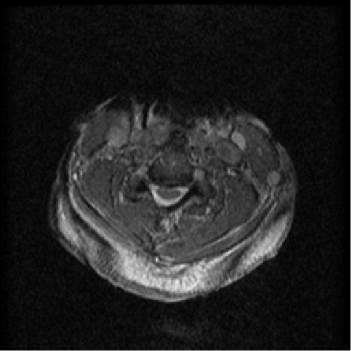 Cervical canal stenosis with cord compression (Radiopaedia 34114-35374 Axial Gradient Echo 45).png