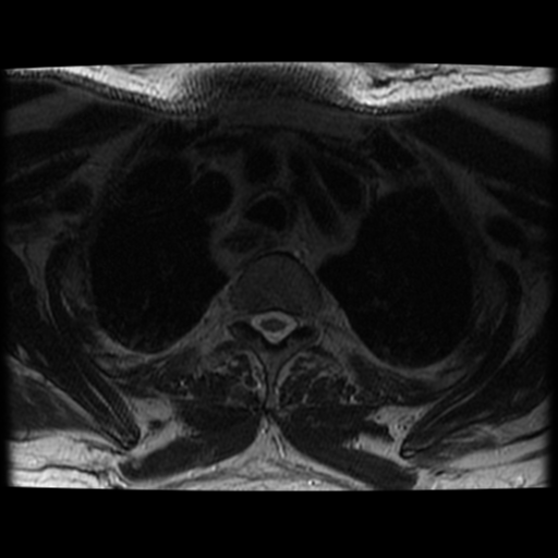 File:Cervical canal stenosis with cord compression (Radiopaedia 34114-35374 Axial T2 2).png