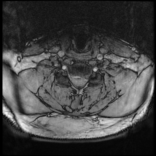 Cervical disc extrusion (Radiopaedia 59074-66364 G 66).jpg