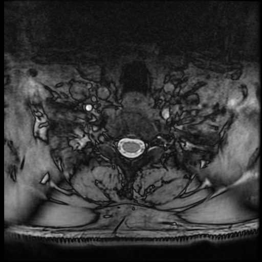 Cervical disc extrusion (Radiopaedia 59074-66364 G 94).jpg