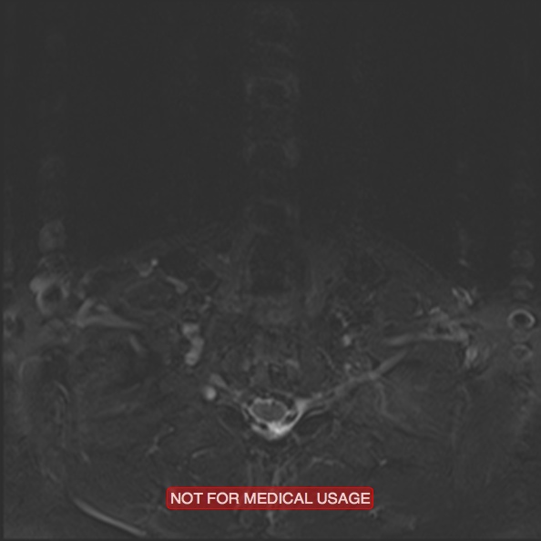 Cervical nerve schwannoma (Radiopaedia 27964-28221 C 45).jpg