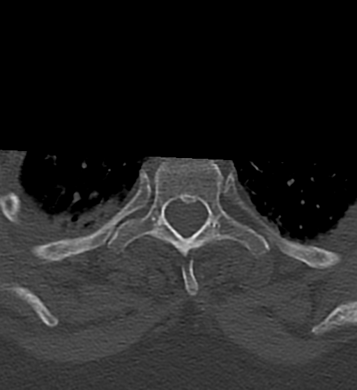 Cervical spine ACDF loosening (Radiopaedia 48998-54070 Axial bone window 62).png