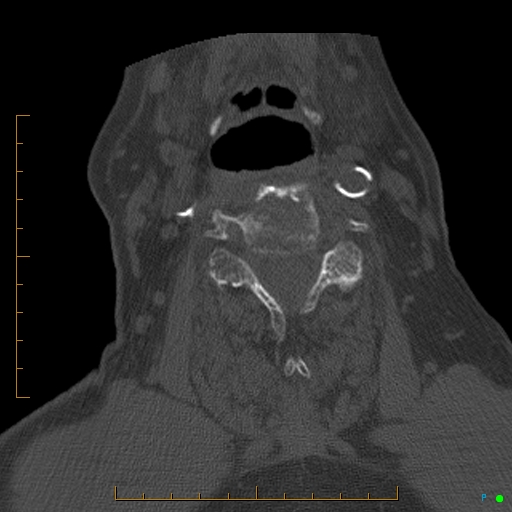 Cervical spine fracture - ankylosing spondylitis (Radiopaedia 76835-88706 Axial bone window 115).jpg