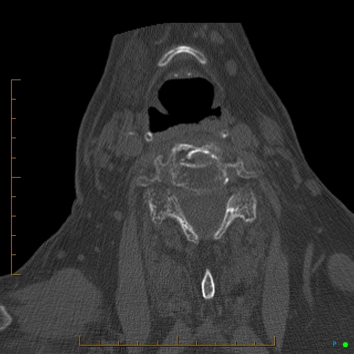 Cervical spine fracture - ankylosing spondylitis (Radiopaedia 76835-88706 Axial bone window 134).jpg
