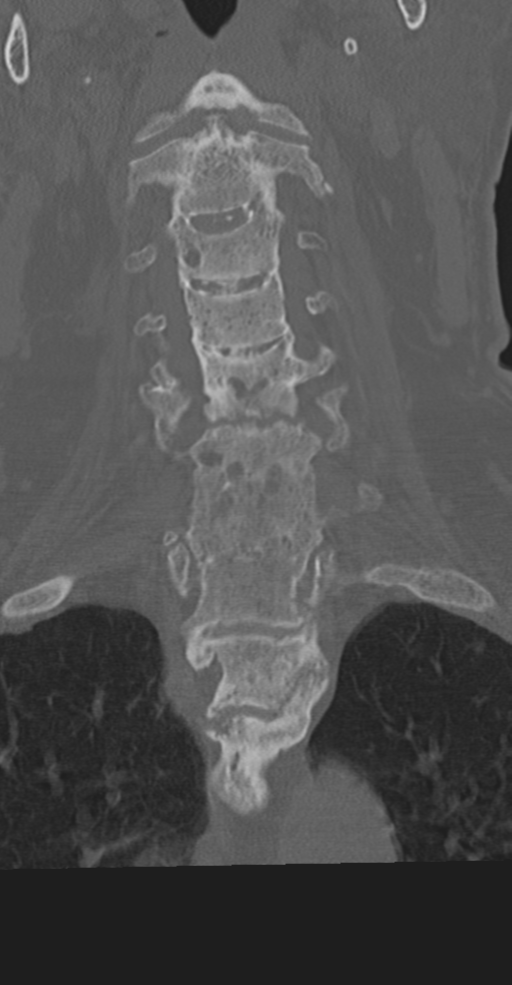 Cervical spine fracture in the setting of ankylosis (Radiopaedia 37038-38715 Coronal bone window 29).png