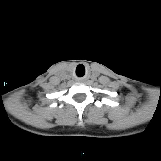 File:Cervical thymic cyst (Radiopaedia 88632-105335 Axial non-contrast 40).jpg