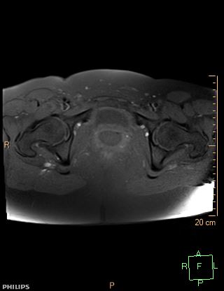 File:Cesarian scar endometriosis (Radiopaedia 68495-78066 Axial T1 fat sat 21).jpg