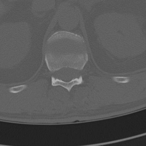 Chance fracture (Radiopaedia 33854-35020 Axial bone window 90).png