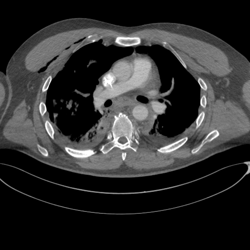 File:Chest multitrauma - aortic injury (Radiopaedia 34708-36147 A 136).png