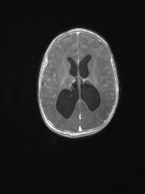 Chiari III malformation with occipital encephalocele (Radiopaedia 79446-92559 Axial T1 C+ mpr 55).jpg