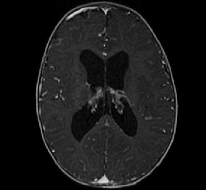 Chiasmatic-hypothalamic glioma (Radiopaedia 90079-107252 Axial T1 C+ 53).jpg