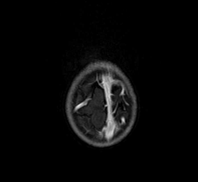 Chiasmatic-hypothalamic glioma (Radiopaedia 90079-107252 Axial T1 C+ 86).jpg