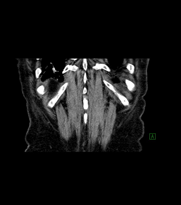Cholangiocarcinoma with cerebral metastases (Radiopaedia 83519-98629 Coronal C+ delayed 75).jpg