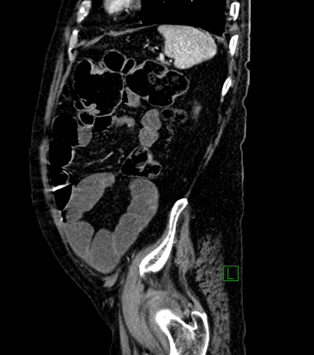 Cholangiocarcinoma with cerebral metastases (Radiopaedia 83519-98629 F 29).jpg