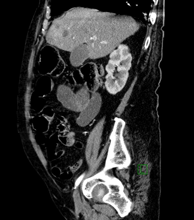 Cholangiocarcinoma with cerebral metastases (Radiopaedia 83519-98629 F 84).jpg