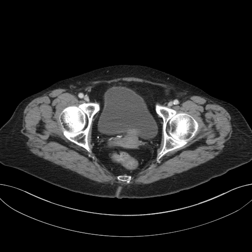 Cholecystoduodenal fistula due to calculous cholecystitis with gallstone migration (Radiopaedia 86875-103077 D 75).jpg