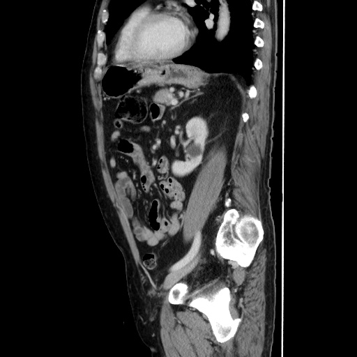 Choledocholiathiasis with normal caliber common bile duct (Radiopaedia 75368-86632 D 105).jpg